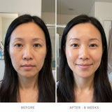 AURATA Micro-Infusion Facial System