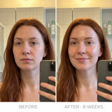 AURATA Micro-Infusion Facial System