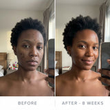 AURATA Micro-Infusion Facial System